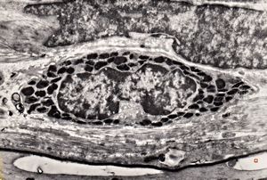 M,3y. | mast cell - n. suralis, Krabbe globoid leukodystrophy M,3y. | mast cell - n. suralis, Krabbe globoid leukodystrophy